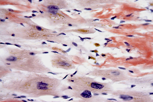 Congo red staining showing amyloid and lipofuscin in an autopsy specimen of senile cardiac amyloidosis