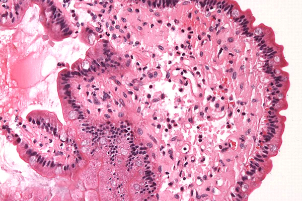 Hematoxylin and eosin (H&E) staining showing amyloid deposition in the lamina propria of the duodenum, 20X magnification