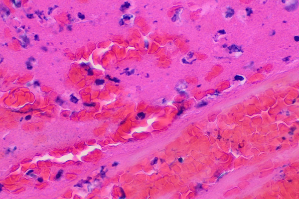 Hematoxylin and eosin (H&E) staining of nuclear debris, fibrin, and red blood cells in a fresh thrombus