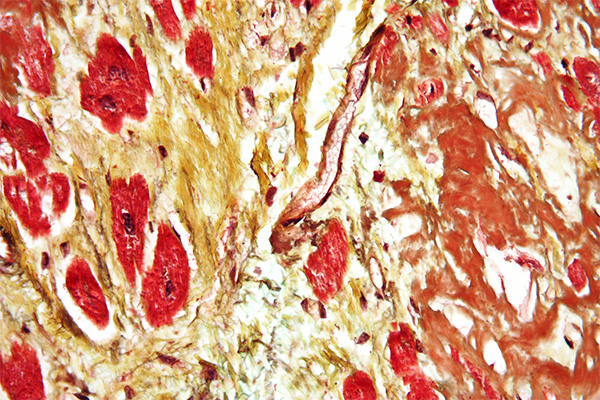 Movat staining showing amyloid, lipofuscin, and myocardial fibrosis in an autopsy of senile cardiac amyloidosis