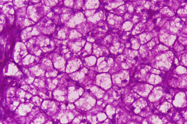 Periodic acid Schiff staining in liver biopsy of glycogen storage disorder, 20X magnification