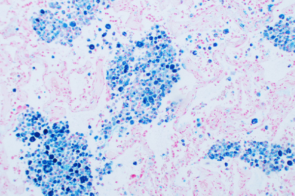Perls' Prussian blue staining of lung tissue with pulmonary veno-occlusive disease